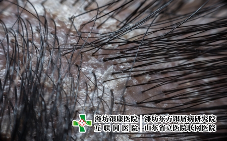 摄图网_329518744_毛发头皮 有淋巴虫病和皮肤炎地衣压力药物过敏分泌卫生头皮屑头发皮肤宏观（企业商用）