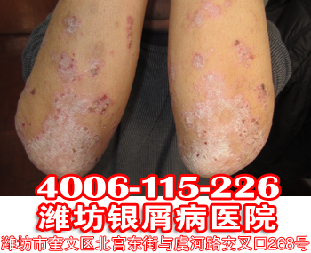 银屑病护理