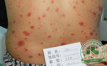 　医生提醒：银屑病治疗不可拖延