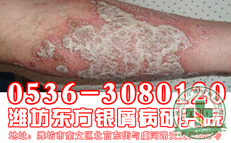 全身型牛皮癣该怎么治疗？