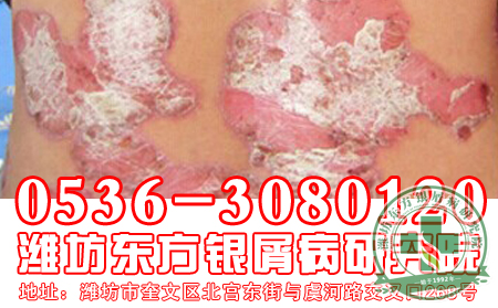 治银屑病找东方，东方给你新希望
