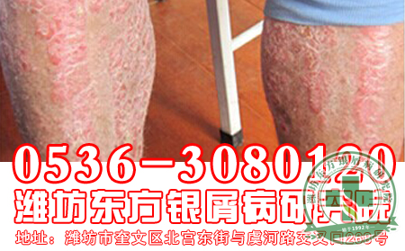 潍坊牛皮癣专科医院——冬季来临，牛皮癣预防是关键