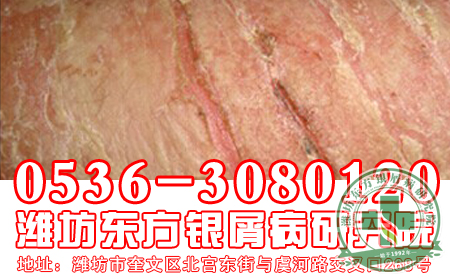 潍坊牛皮癣医院——帮助牛皮癣恢复的“小窍门”，你知道吗？