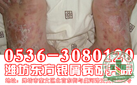 银屑病发病后患者应该有什么样的心理状态