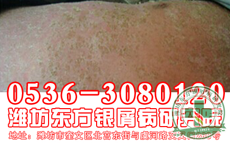警惕！饮食不合理，银屑病找上你