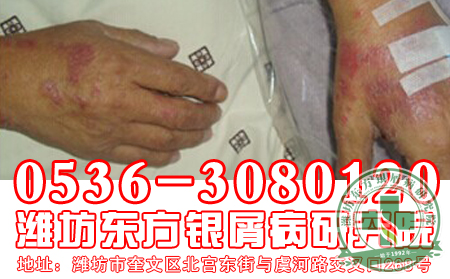 山东牛皮癣医院讲解儿童牛皮癣治疗注意事项【共同关注】
