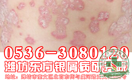 潍坊治疗牛皮癣专科医院脚底按摩治治治疗效果果果可以吗？