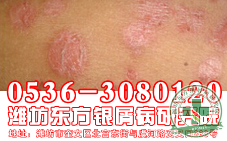 山东牛皮癣医院介绍患者要禁忌的生活习惯