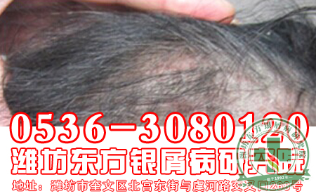 山东牛皮癣医院告诉大家女性牛皮癣预防怎么做？