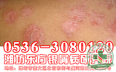 　　山东牛皮癣专科医院——女性牛皮癣患者注意了！三个坏习惯让