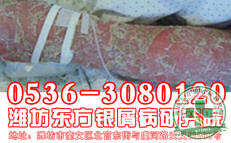 潍坊牛皮癣医院医生答疑：牛皮癣患者为何要戒酒？
