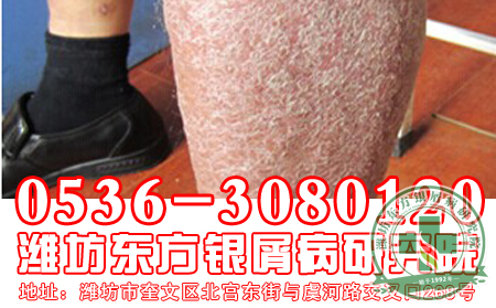 山东治疗牛皮癣专科医院患者怎样补充水分