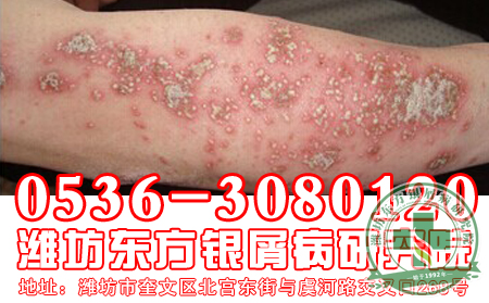 潍坊牛皮癣专科医院医生呼吁：关爱老年牛皮癣患者身体健康