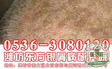 山东牛皮癣专科医院：对于儿童出现的银屑病要注意什么