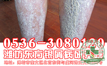 牛皮癣患者关注：怎样控制牛皮癣病情?