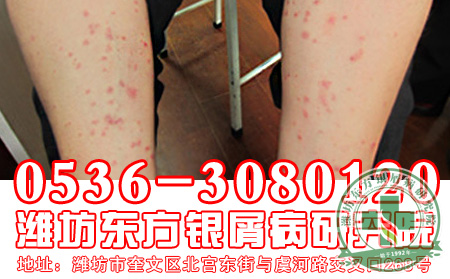 牛皮癣患者出门要注意什么?