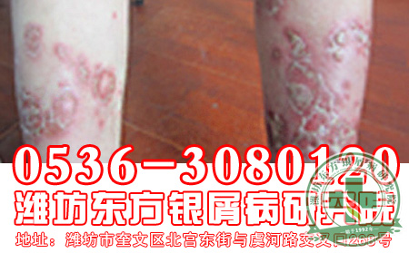 牛皮癣患者需要给予特殊照顾吗?
