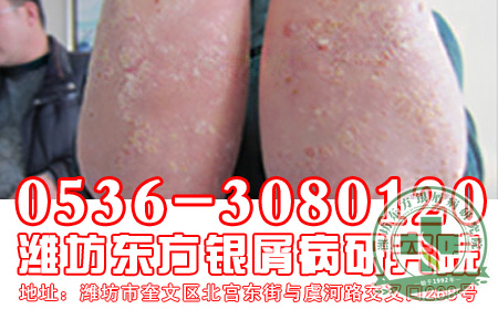 怎样有效的避免牛皮癣复发呢?