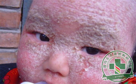 儿童牛皮癣患者应该怎样治疗？