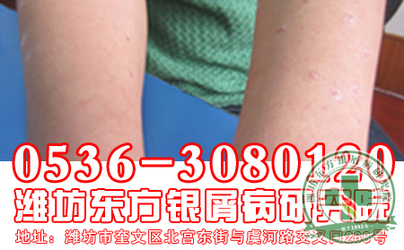 女性牛皮癣患者生理期如何护理呢?