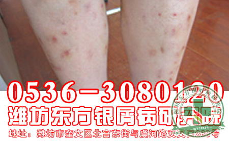 秋季老年牛皮癣患者保健常识