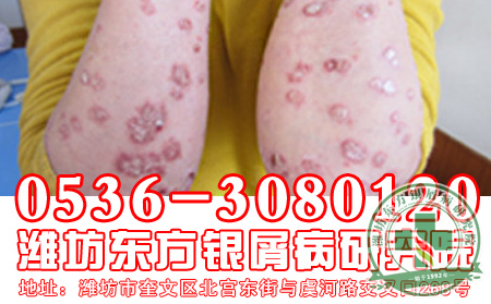 秋季儿童牛皮癣患者保健小常识