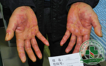 说可以的、 呢？银屑病患者亲口讲述：