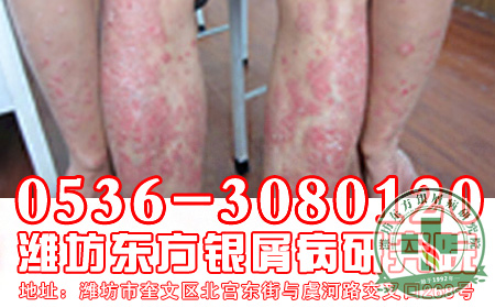 哪些因素会影响牛皮癣治疗呢?