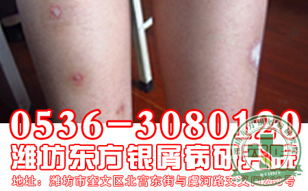 治疗牛皮癣要注意什么呢?