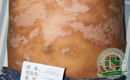 牛皮癣患者夏季饮食有什么讲究？