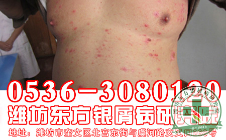 银屑病的消退表现是怎样的？