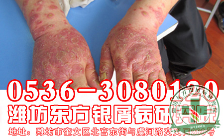 银屑病治疗的药物有很多，你知道怎么选择吗？