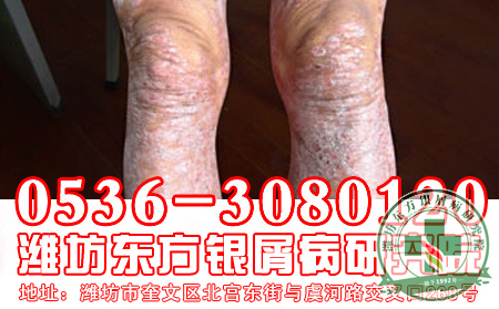 银屑病的护理工作要注意哪些方面？