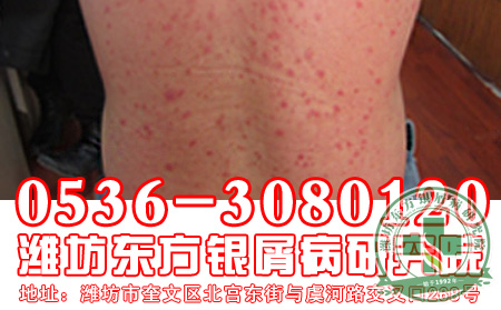 有多少原因会造成银屑病的发生？