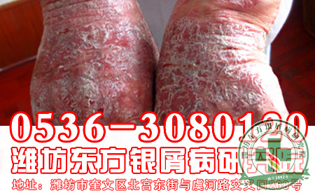 脓疱型银屑病的症状患者要注意什么？