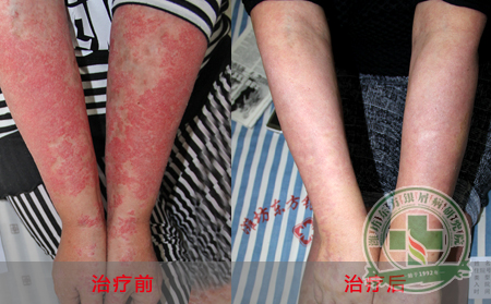 银屑病发病过程中会有什么症状表现？
