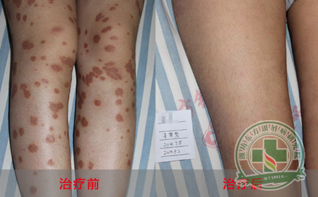 银屑病患者的治疗要怎样做？