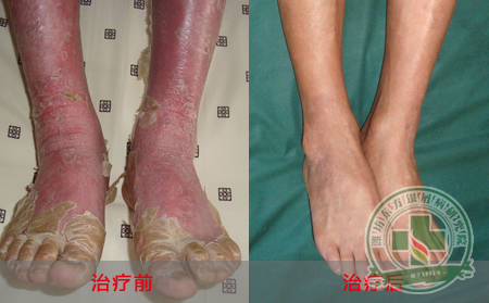 银屑病的发病原因到底有什么？