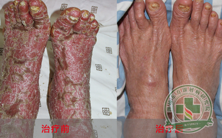 寻常型银屑病的症状有什么呢？