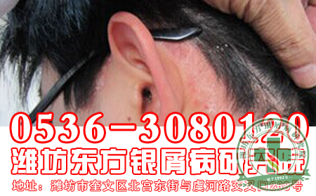 银屑病洗头有什么可以处？