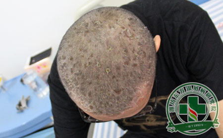 医生教您预防牛皮癣患者的头屑过多