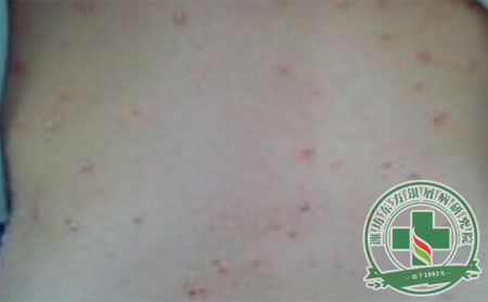 咽喉发病会影响牛皮癣吗？