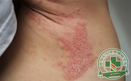 必知的牛皮癣的病症特点