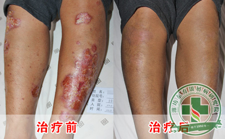 与银屑病患者亲密接触，会被传染吗？