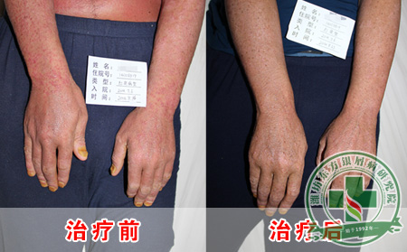 病例分析银屑病可以治疗方法