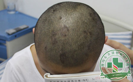 潍坊昌乐牛皮癣症状怎么治疗