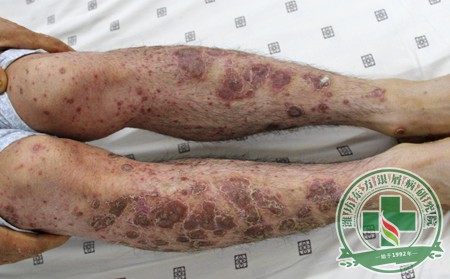 如何确保患者知道银屑病危害是什么