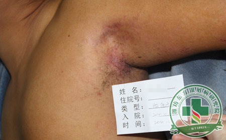 银屑病患者心烦意乱是抑制还是释放