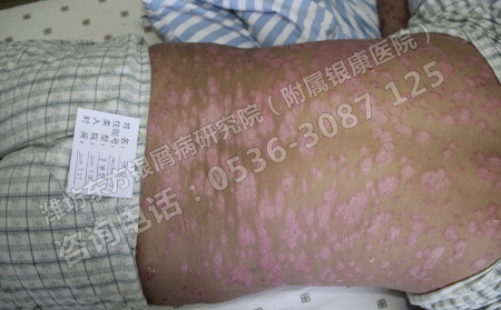 寻常型银屑病患者的治疗哪些问题比较重要