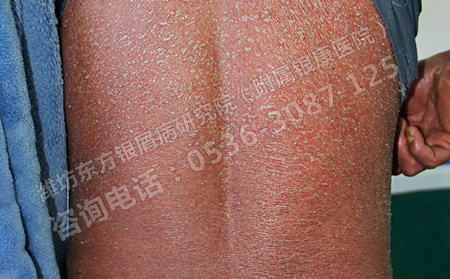 银屑病患者如何选择治疗医院